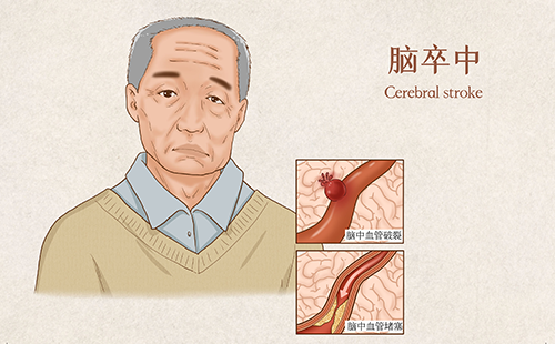 动脉硬化检测仪